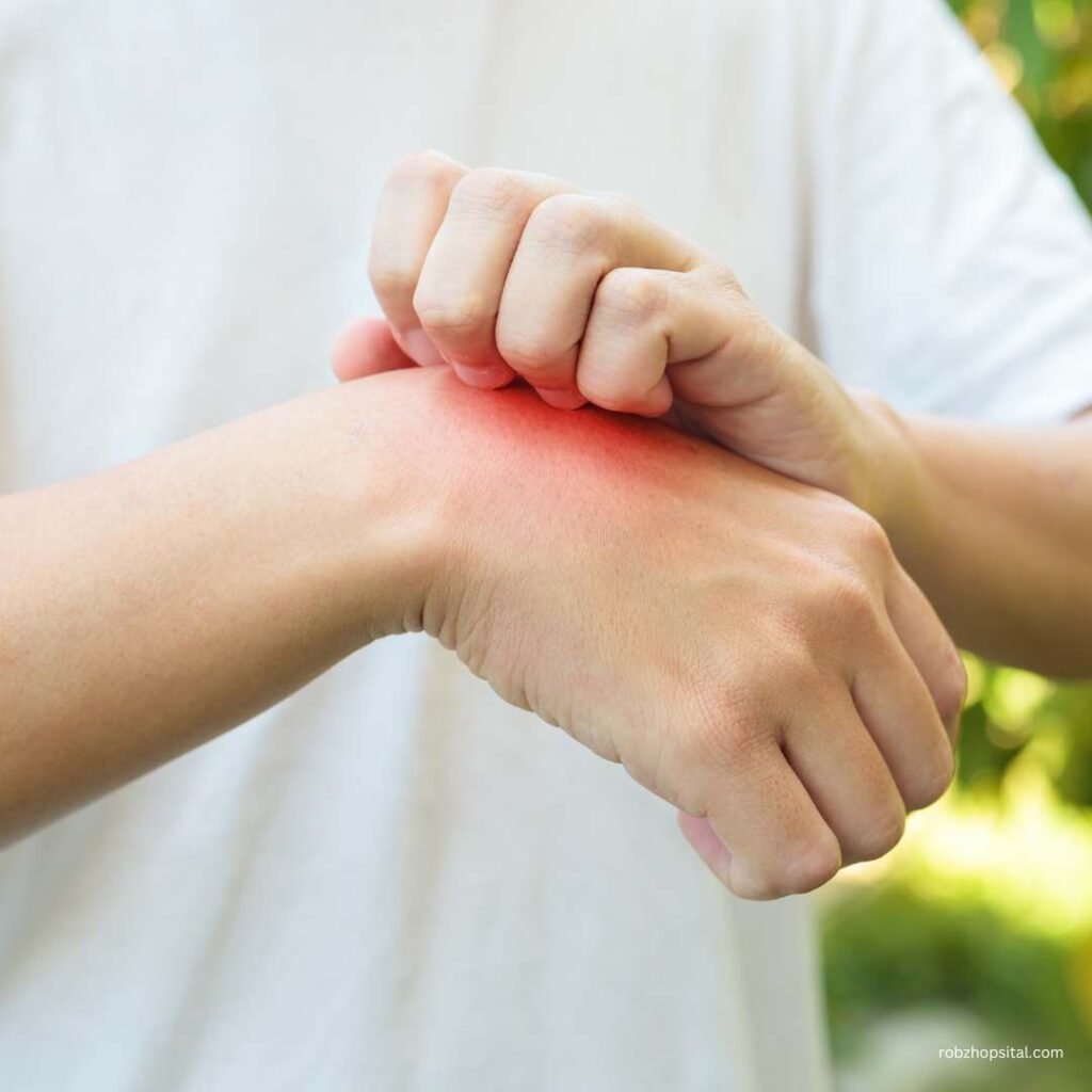 allergy on hands