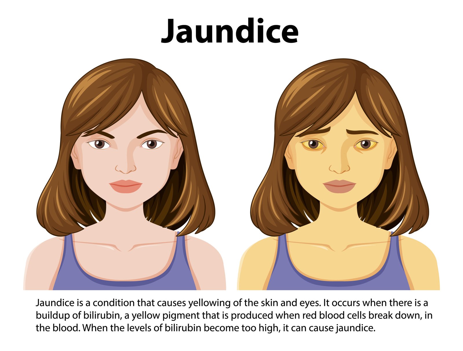 Understanding Jaundice The Yellowing of the Skin and Eyes Robz